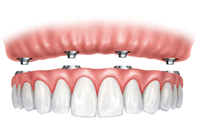 Implant Supported Dentures in Cincinnati, OH