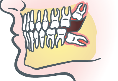 Wisdom Teeth Extraction in Cincinnati, OH