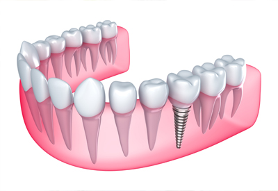 Single Missing Tooth in Cincinnati, OH