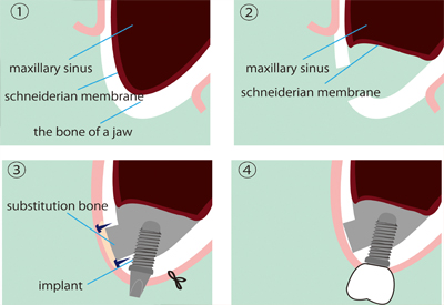 Sinus Lift in Cincinnati, OH